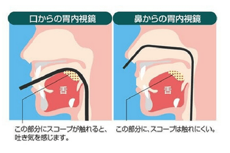 経口または経鼻から選べます